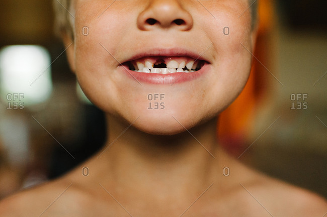 Happy boy showing off missing tooth