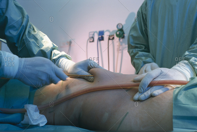 Surgeons perform Liposuction