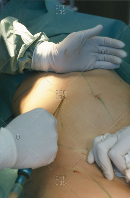 Surgeons perform Liposuction