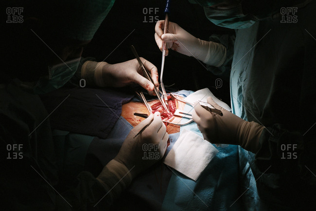 Surgeons performing arotid artery surgery for a blood clot.