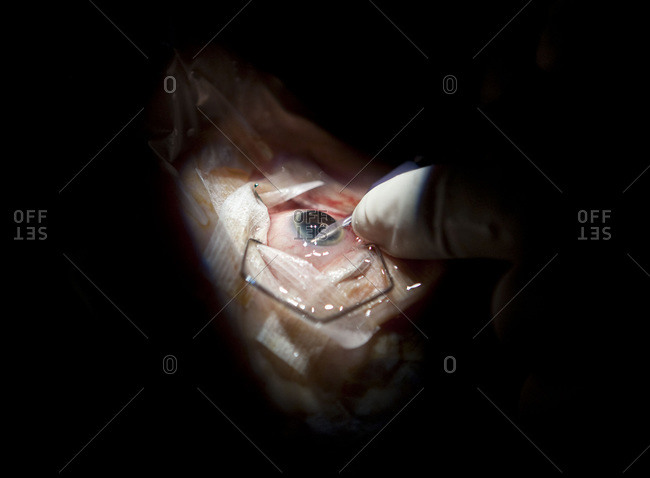 Patient undergoing an ocular implant