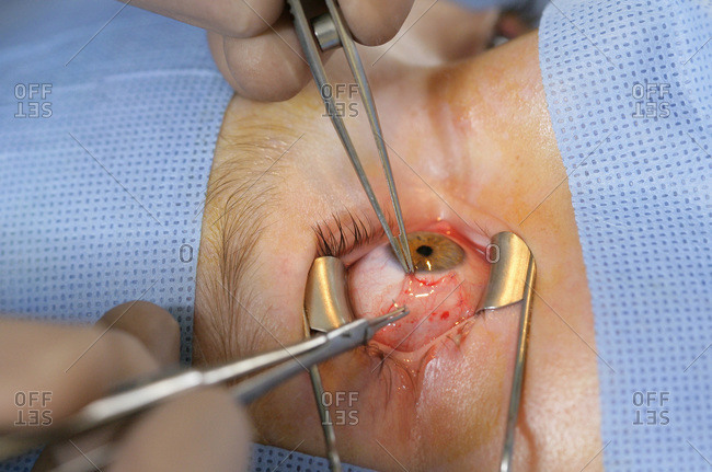 Patient undergoing eye surgery