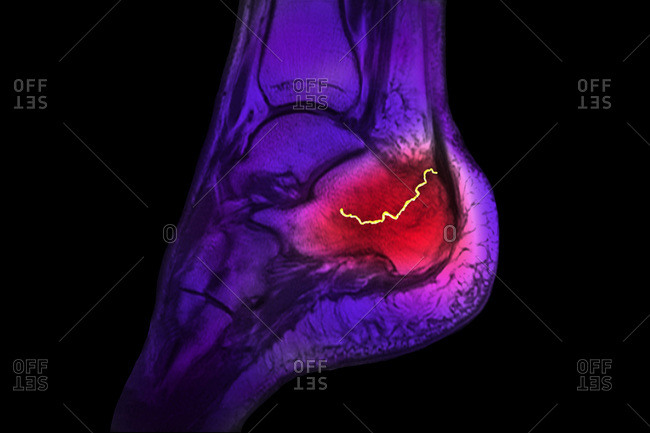 Calcaneum fracture, x-ray