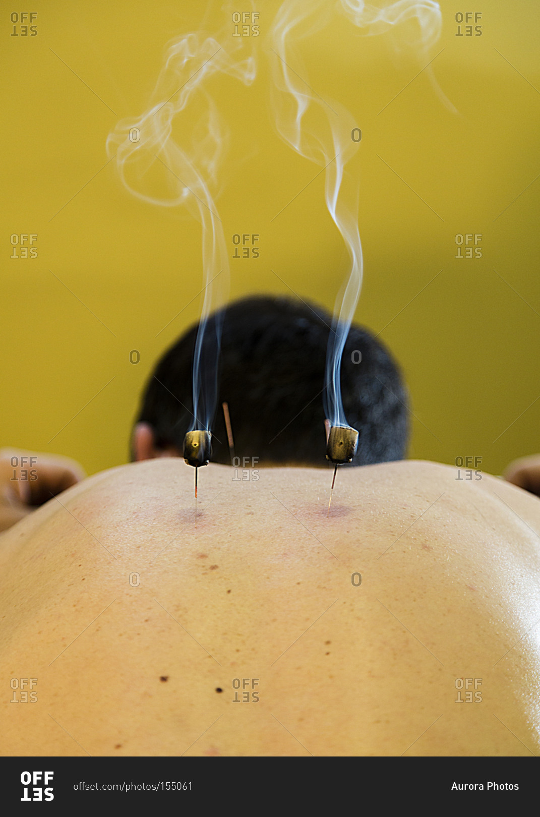 Person receiving an acupuncture treatment