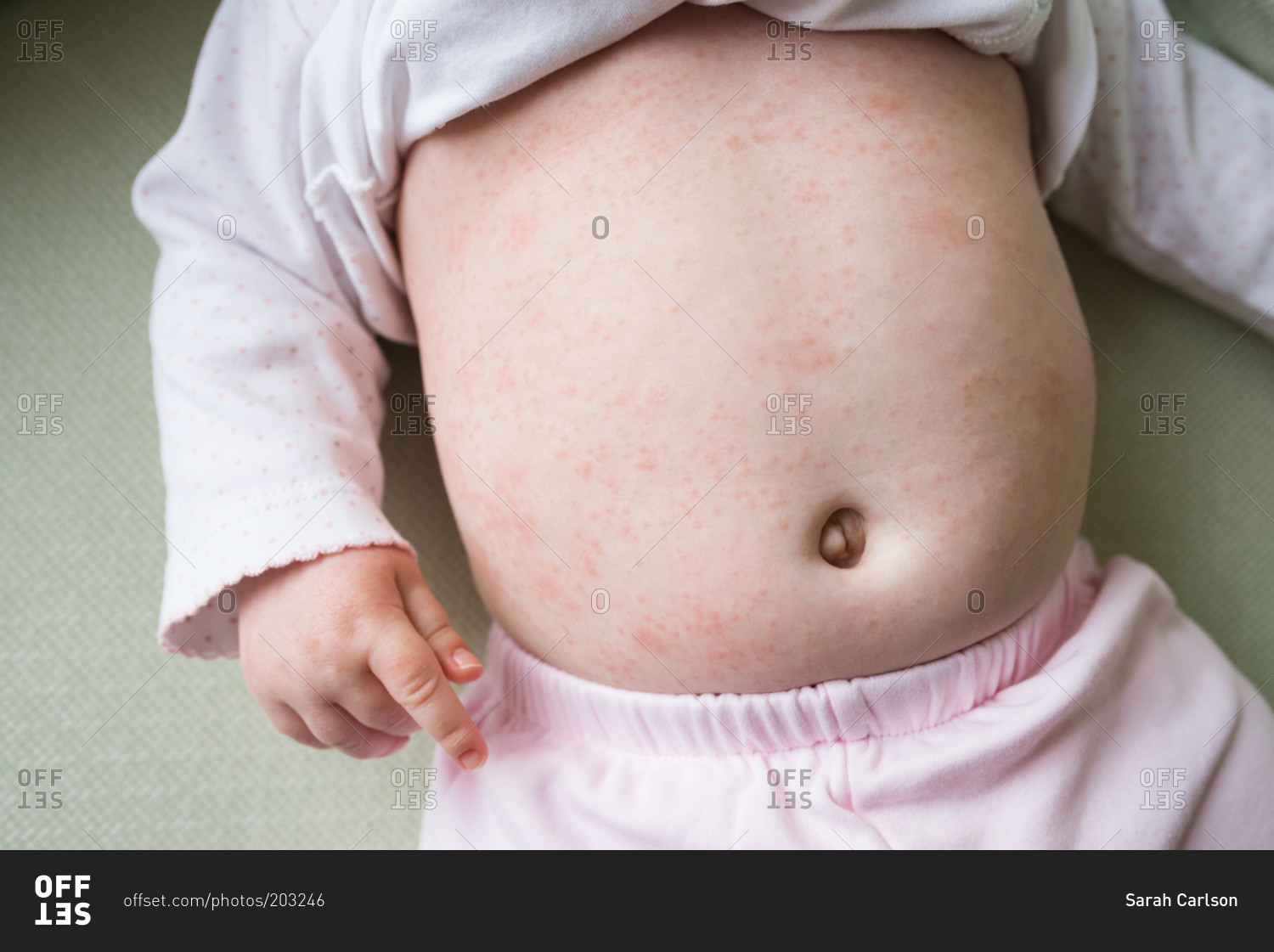 Baby Girl Having An Allergic Reaction On Her Belly Stock Photo Offset