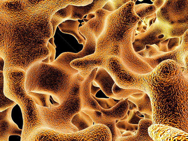 Illustration of the trabeculae in the cancellous (spongy) bone tissue affected by osteoporosis