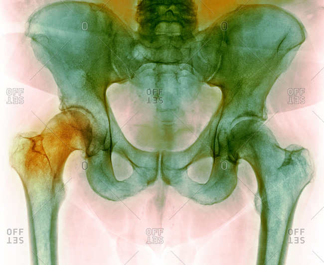 Hip before hip replacement surgery