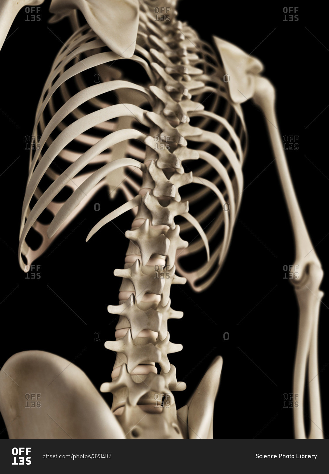 Broken backbone, illustration - Stock Image - C036/3985 - Science Photo  Library