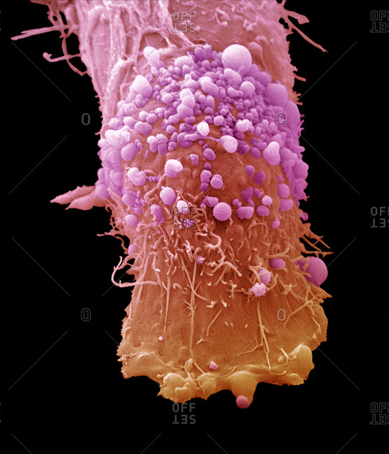 Skin cancer cell, SEM