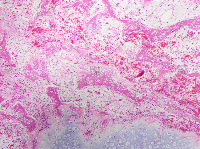 H&E stain, light microscopy, healing fracture callus with exuberant cartilage and new bone formation