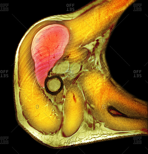 Lipoma of the shoulder, X-ray
