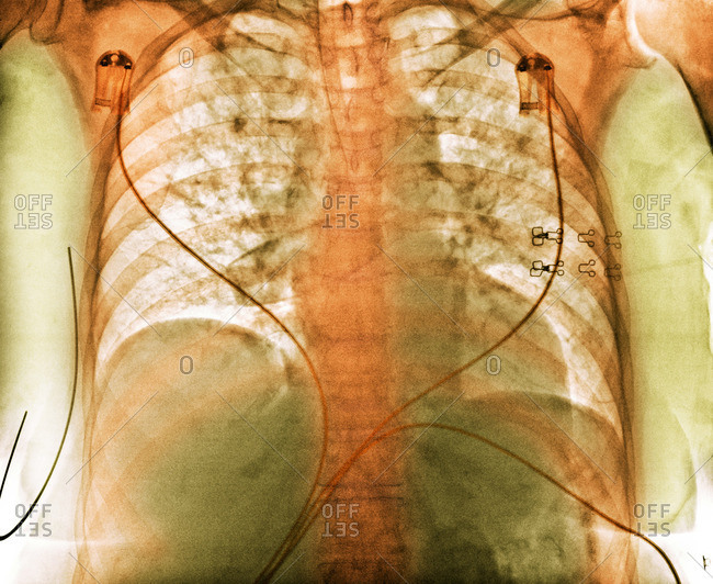 Aspiration, chest X-ray - Offset Collection