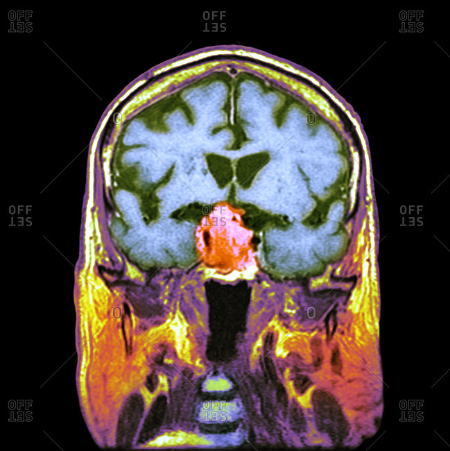 Pituitary tumor, CT scan - Offset