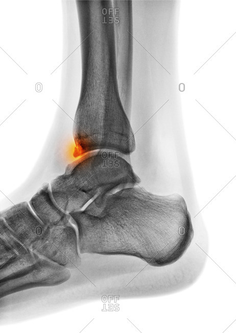 Tibial spur, X-ray - Offset Collection