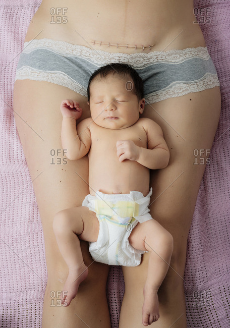 Newborn baby girl lying on mother's thighs near to a recent C-section scar with staples
