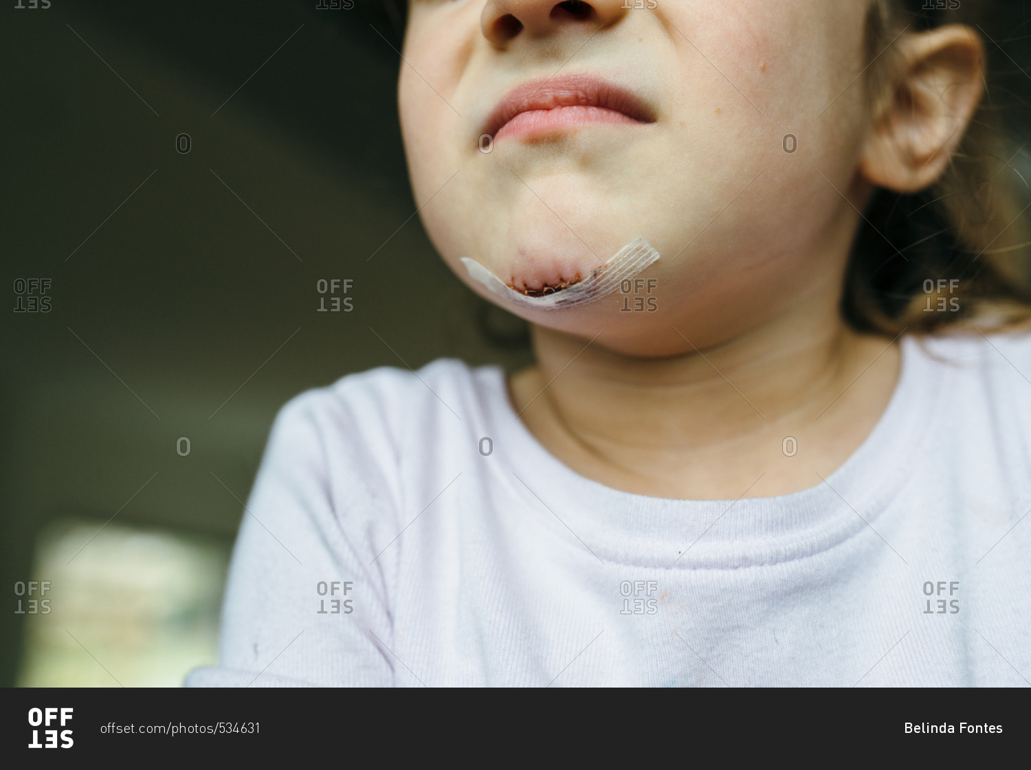 Close up of fresh stitches on a little girl\'s chin