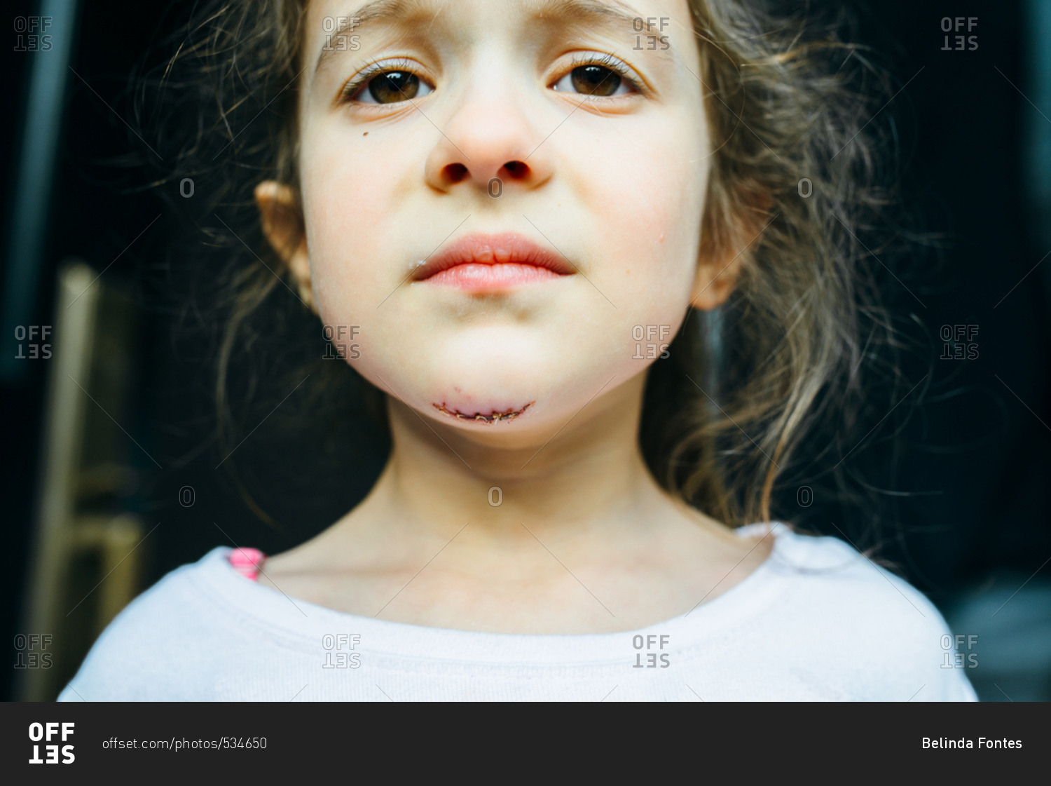 Little girl with fresh stitches on her chin