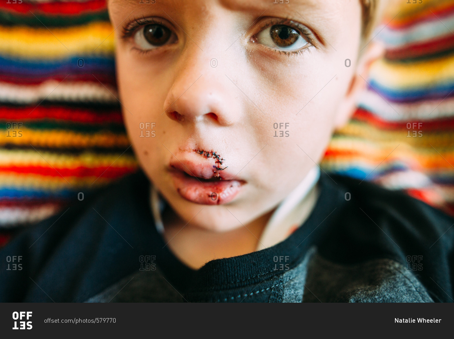 Portrait of a boy with stitches on his upper lip