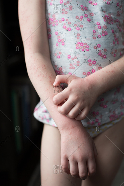 Midsection of girl with allergic skin reaction scratching her arm