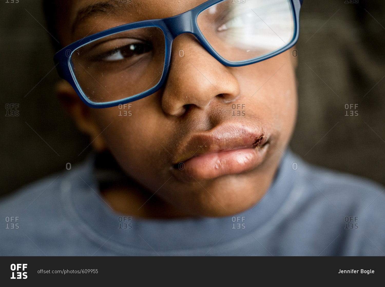 Boy wearing glasses with swollen lip and stitches stock photo - OFFSET