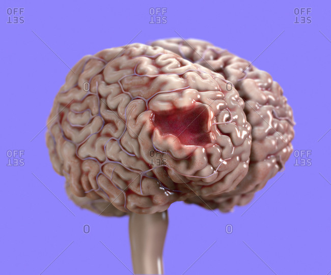 Brain damage, illustration