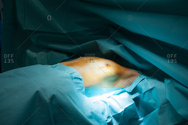 November 4, 2014: Report to the clinic of aesthetic surgery Mozart, Nice, France. Placement of breast prostheses, axillary, in a patient without a mammary gland, the surgeon photographs his chest before the operation