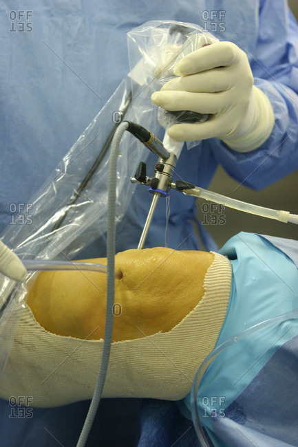 Knee Arthroscopy