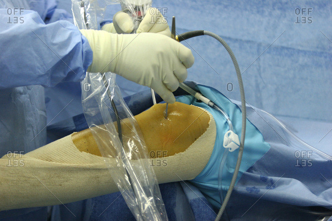 Knee Arthroscopy