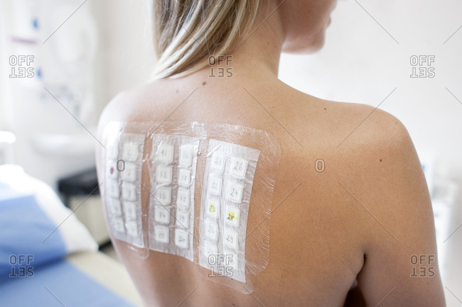 Patient undergoing a patch test in allergy clinic