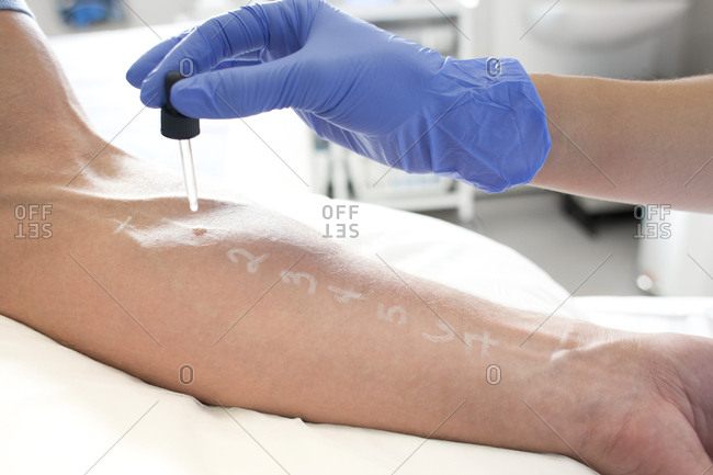Patient undergoing a skin prick test