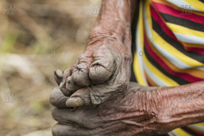 October 3, 2013: Hands Of A Yali Woman Who Cut Her Fingers Whilst Grieving Over The Death Of A Relative, Baliem Valley, Central Highlands Of Western New Guinea, Papua, Indonesia