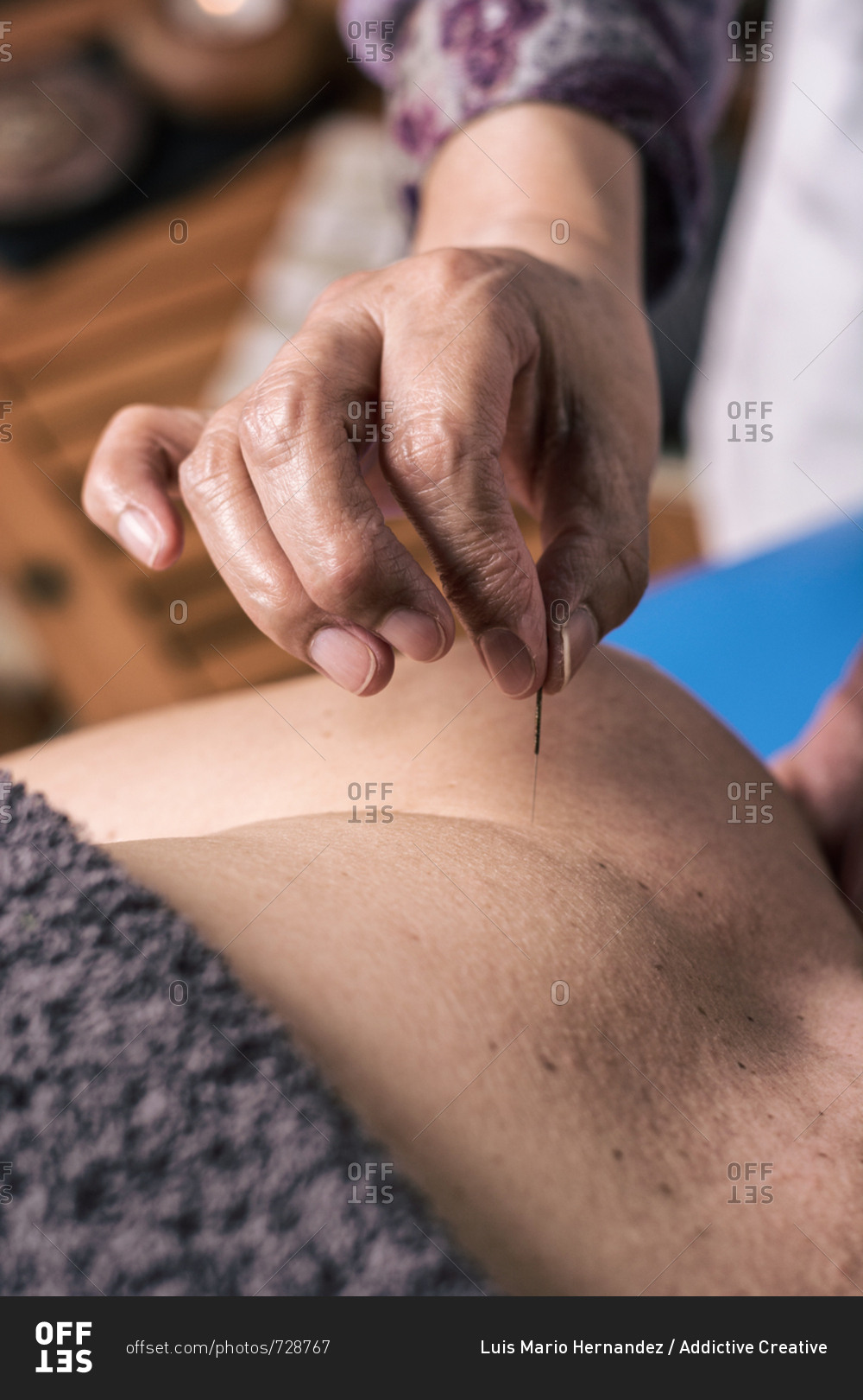 Therapist performing an acupuncture treatment on a patient woman
