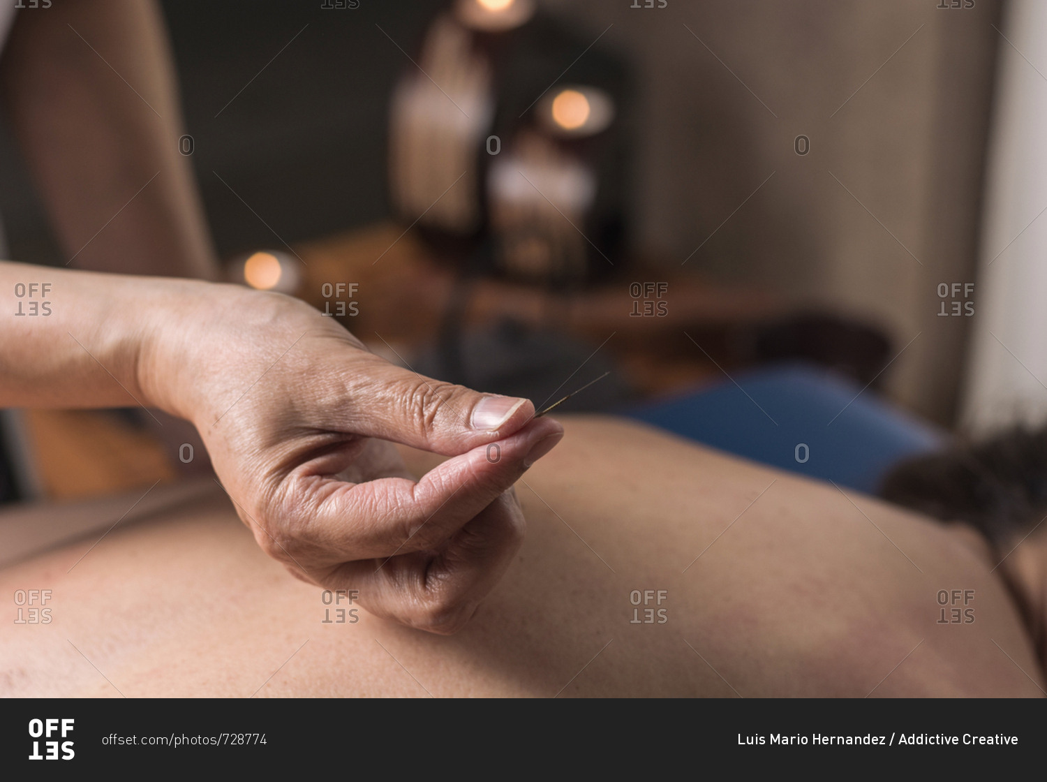 Therapist performing an acupuncture treatment on a patient woman