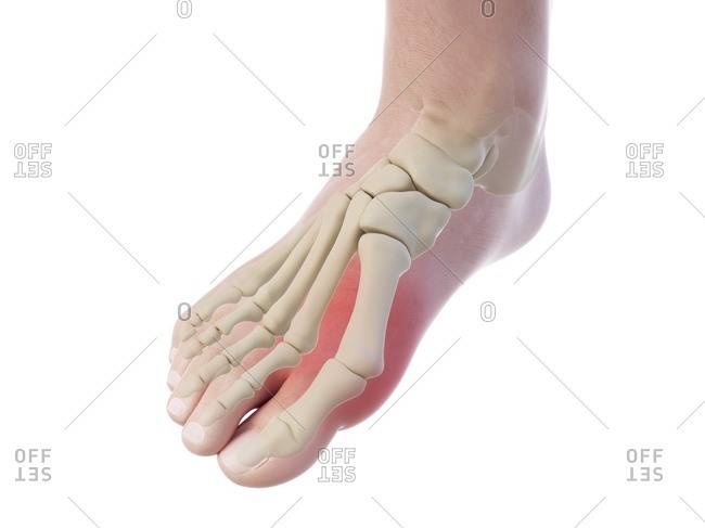 Illustration of a bunion.