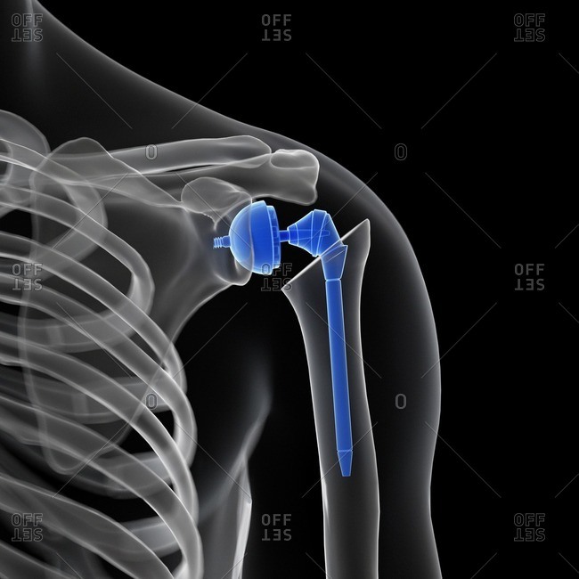 Illustration of a shoulder replacement.