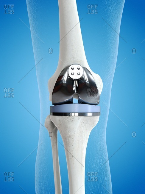 Illustration of a knee replacement.