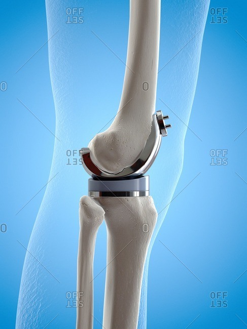 Illustration of a knee replacement.
