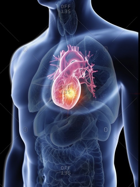 Illustration of a man's heart tumor.