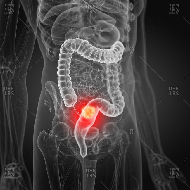 Illustration of colon cancer.