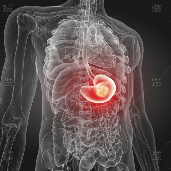 Illustration of stomach cancer.
