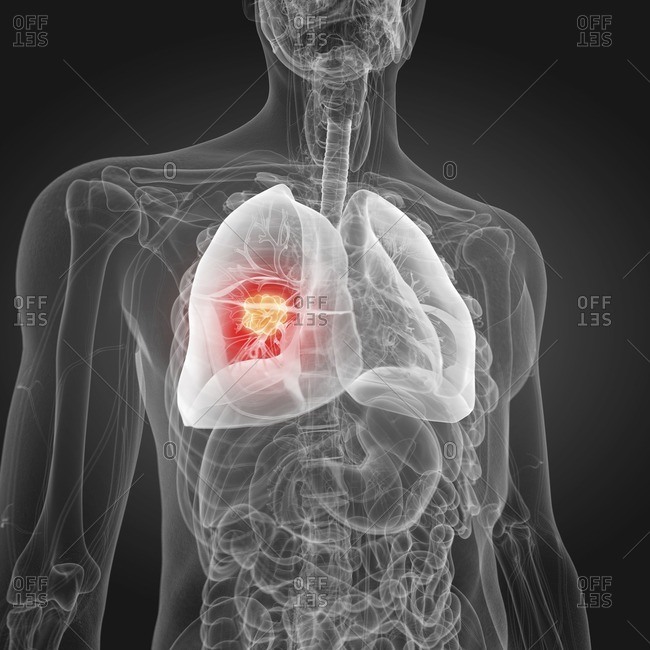 Illustration of lung cancer.