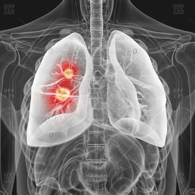 Illustration of lung cancer.