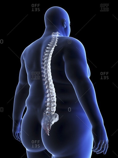 Illustration of an obese man\'s spine.