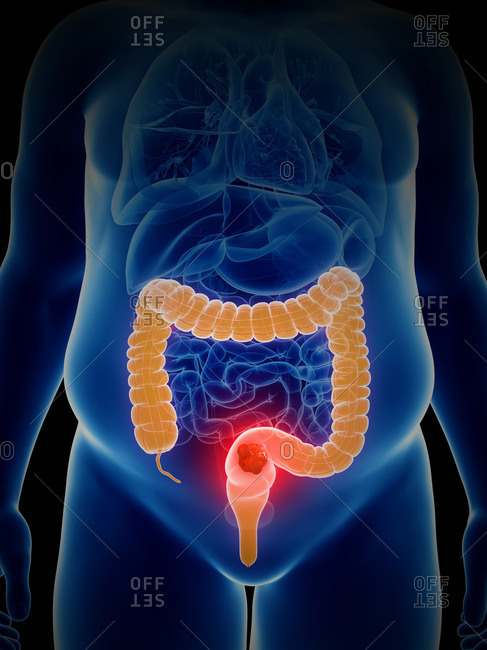 Illustration of colon cancer.