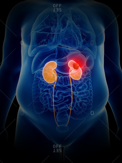 Illustration of kidney cancer.