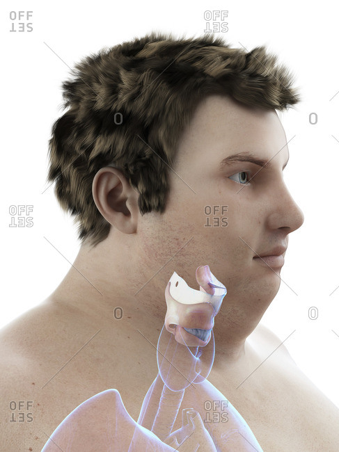 Illustration of an obese man's larynx.