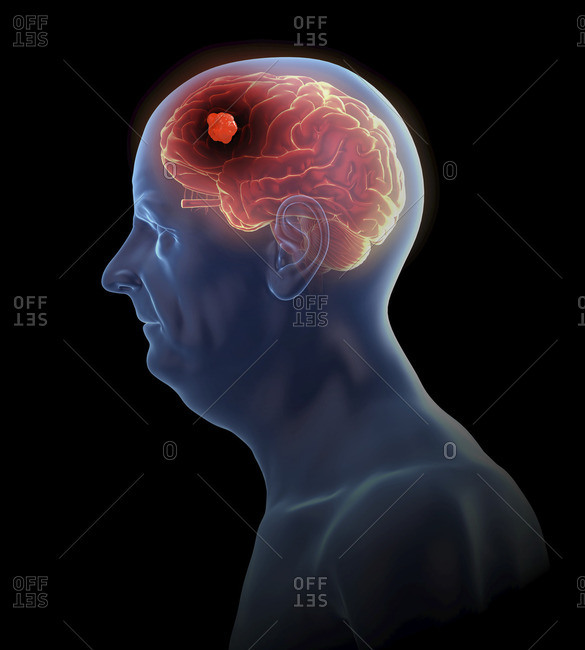 Illustration of a brain tumor.
