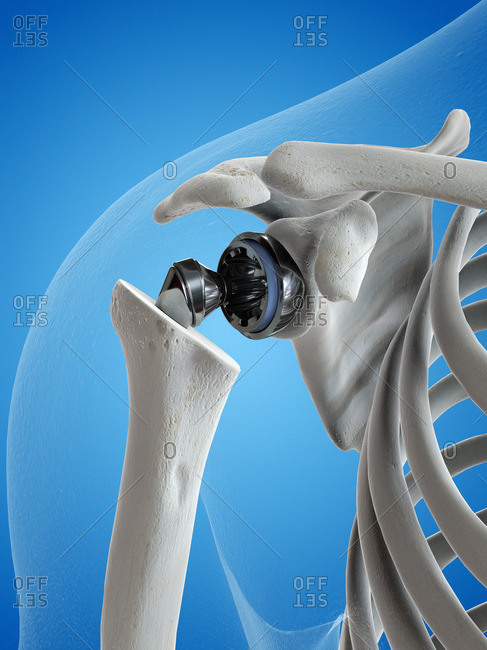 Illustration of a shoulder replacement.