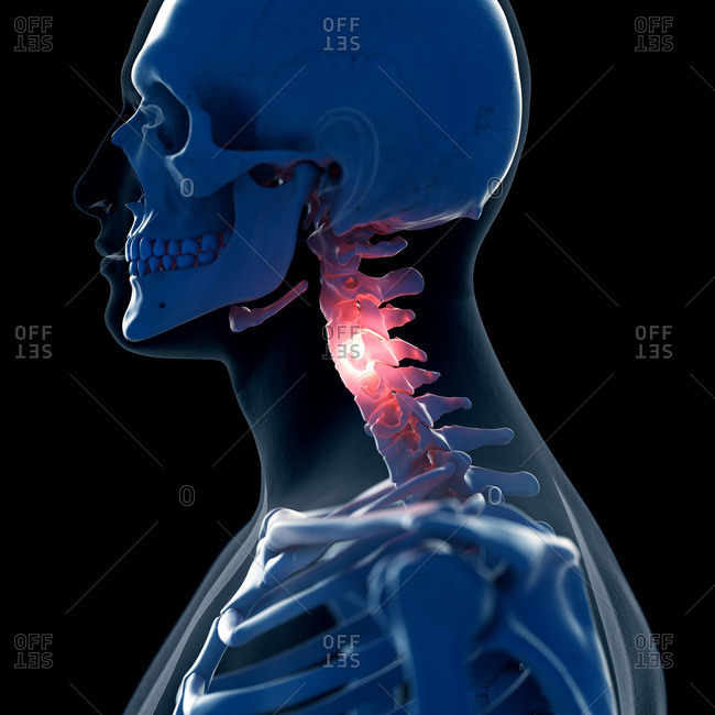 Illustration of a painful neck.
