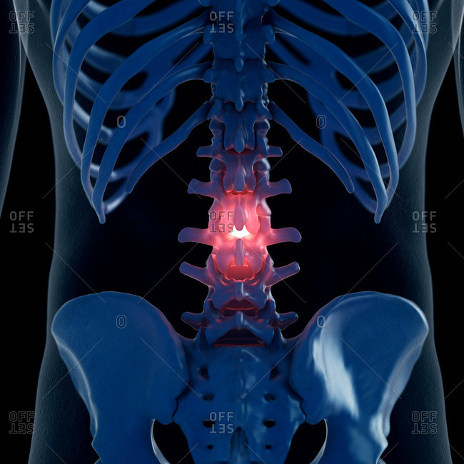 Illustration of a painful lumbar spine.